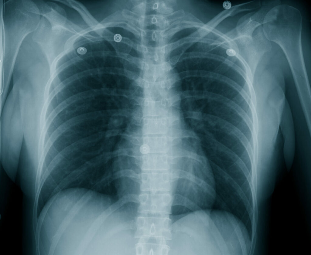 Chest X-ray