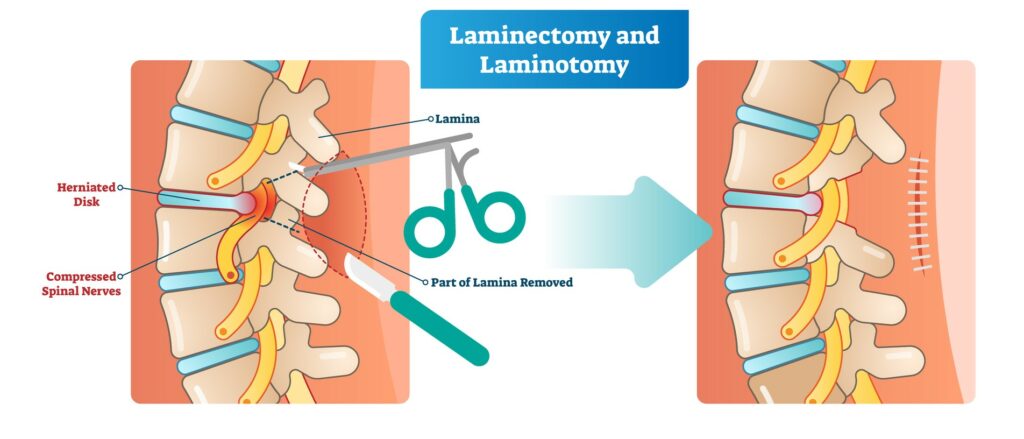 Informational graphic detailing the Laminectomy procedure