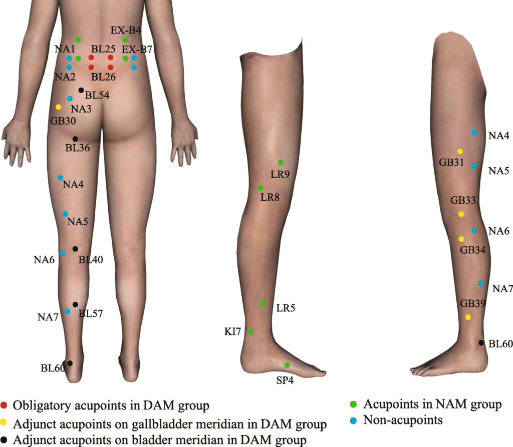 acupuncture points for treatment of sciatica