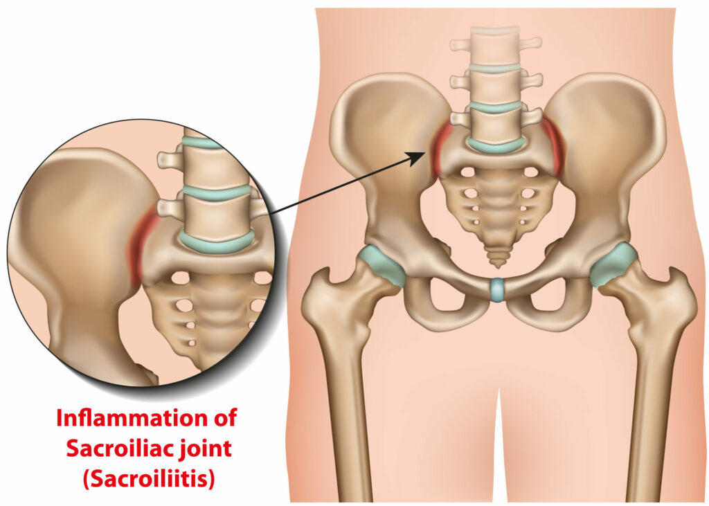 Sacroiliac,Joint,Inflammation,3d,Medical,Vector,Illustration,Sacroiliitis